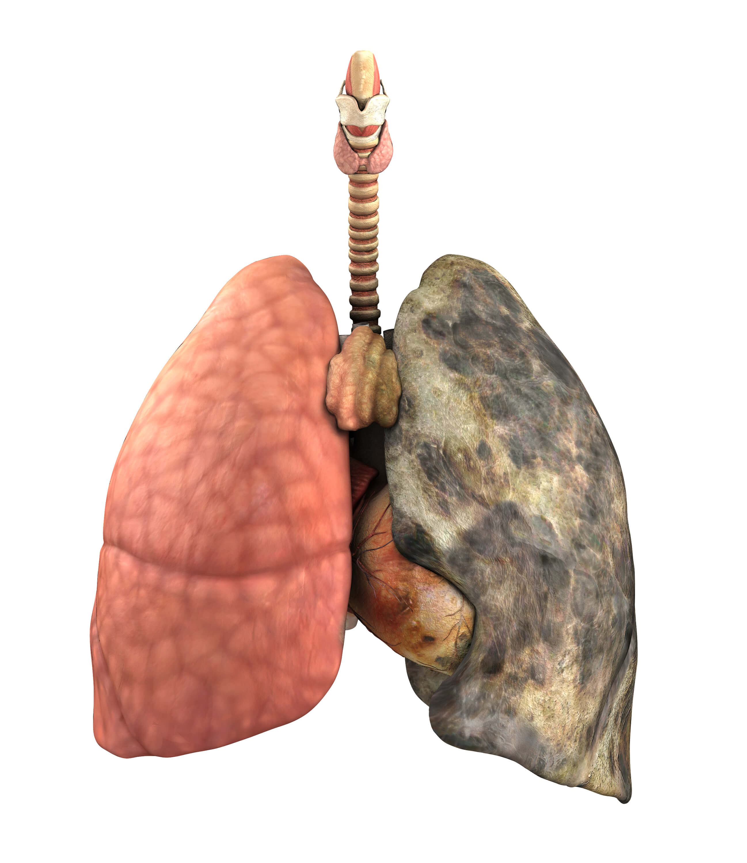 Rak płuca - Rakoobrona